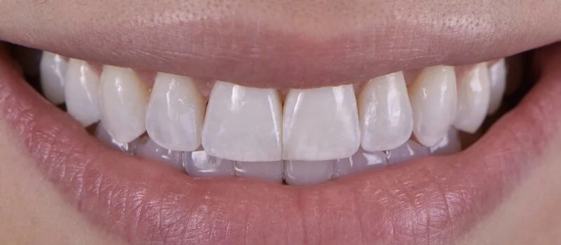 Invisalign After