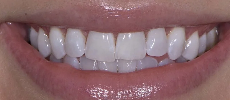 Invisalign Before