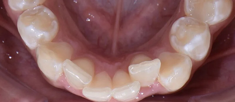 Invisalign Before