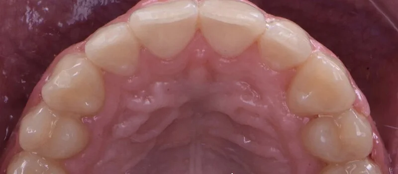 Invisalign After