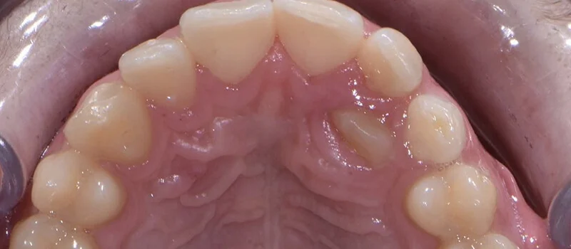 Invisalign Before