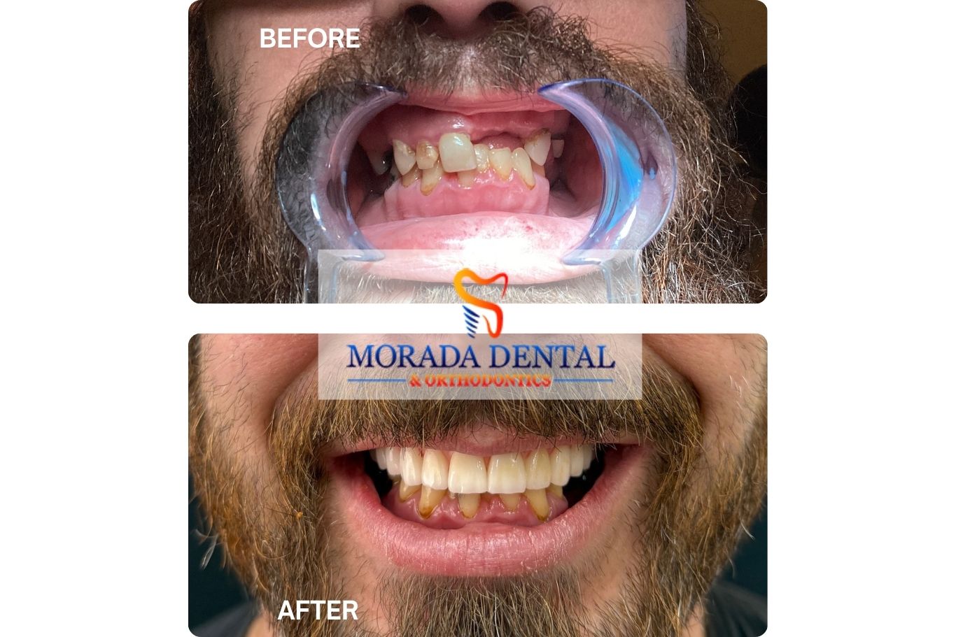 Before and After dental implant male patient at Morada Dental & Orthodontics