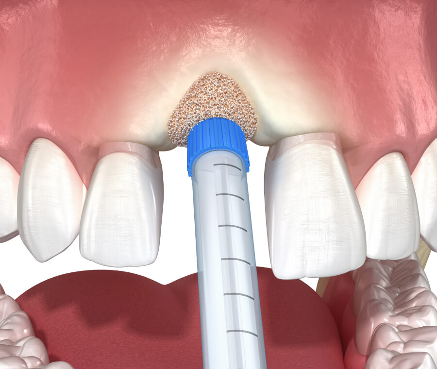Bone Grafting