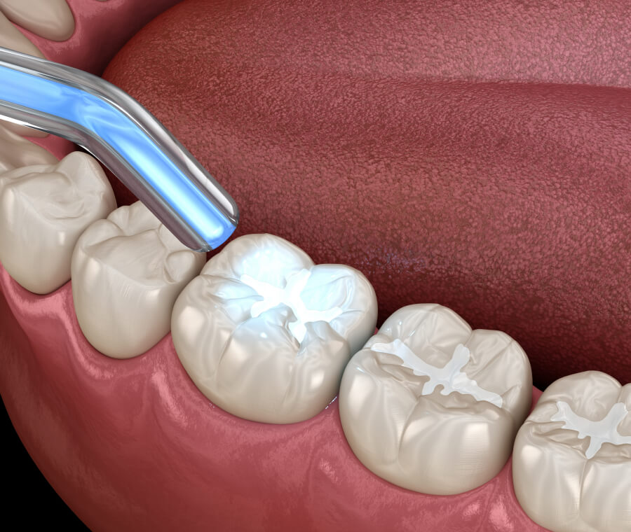 Dental Fillings