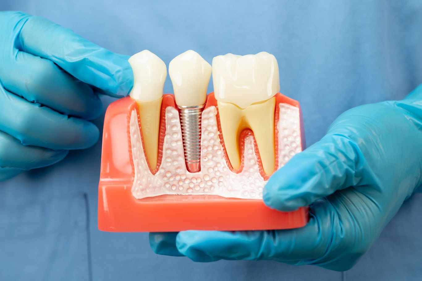Dental implant typodont
