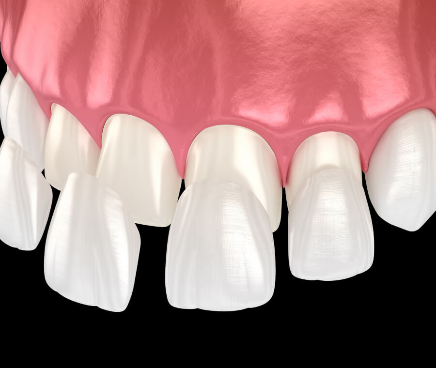 Dental Veneers