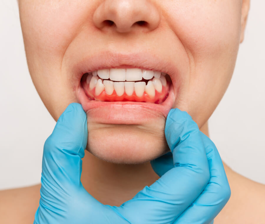 Gum Disease Treatment
