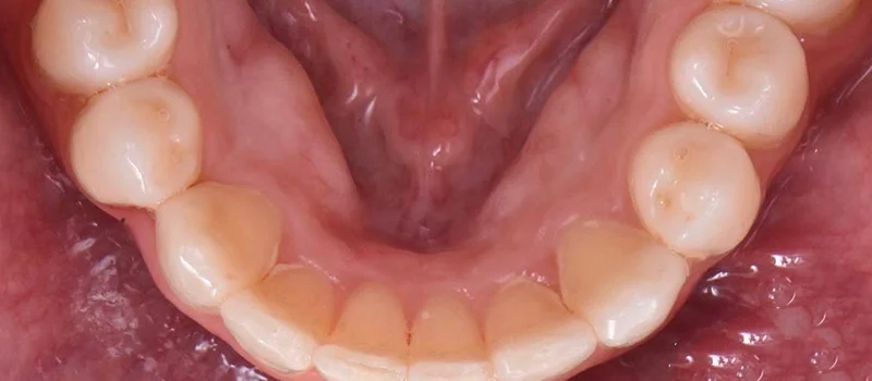 Invisalign After