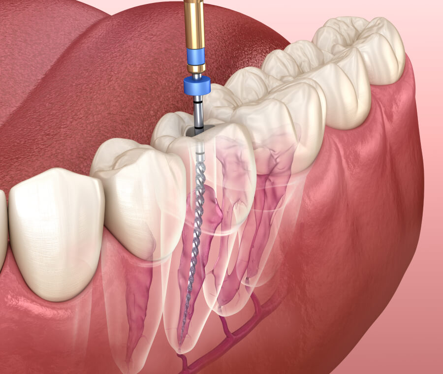 Root Canal Therapy