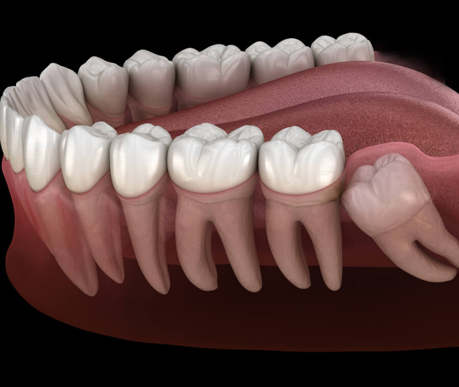 Wisdom Teeth Removal