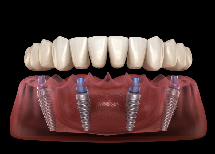 The All-On-4® Technique