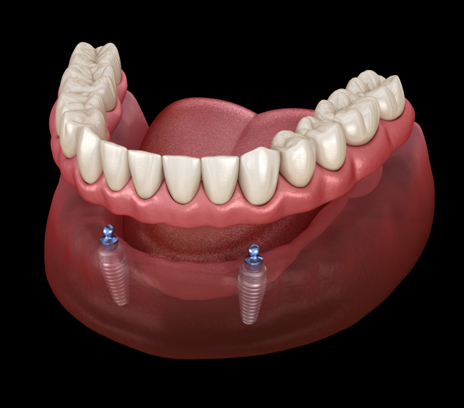 Implant-Supported Dentures