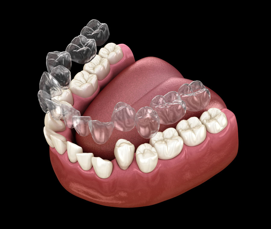 Is Invisalign Right for You?
