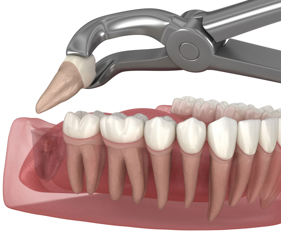 Gentle Tooth Extractions for a Healthier Smile