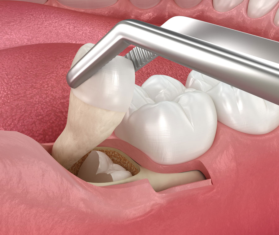 Say Goodbye to Problematic Wisdom Teeth