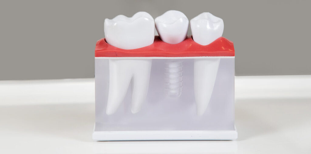 How Long Do Dental Implants Last? A Comprehensive Guide