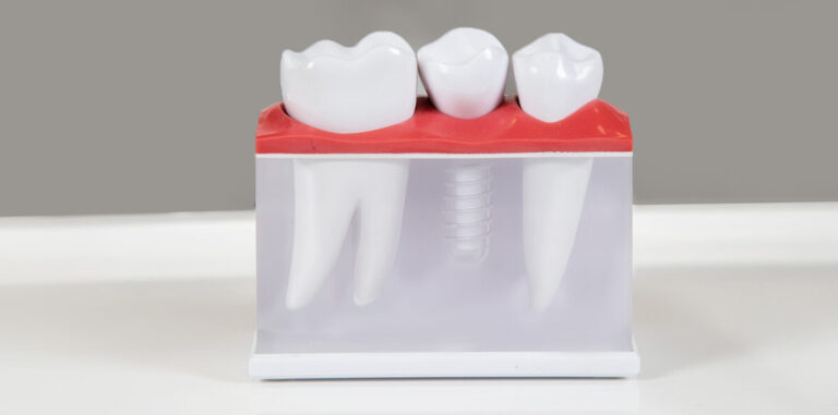 How Long Do Dental Implants Last? A Comprehensive Guide