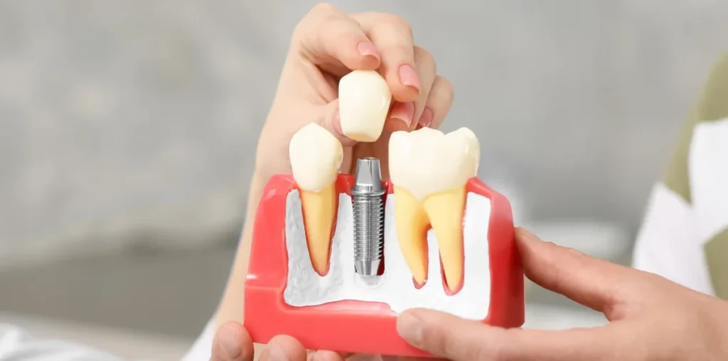 Dental Implant Pressure Sensation: What to Expect and How to Manage It