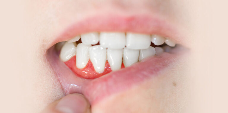 Causes and Remedies for Swollen Gums Behind Front Teeth