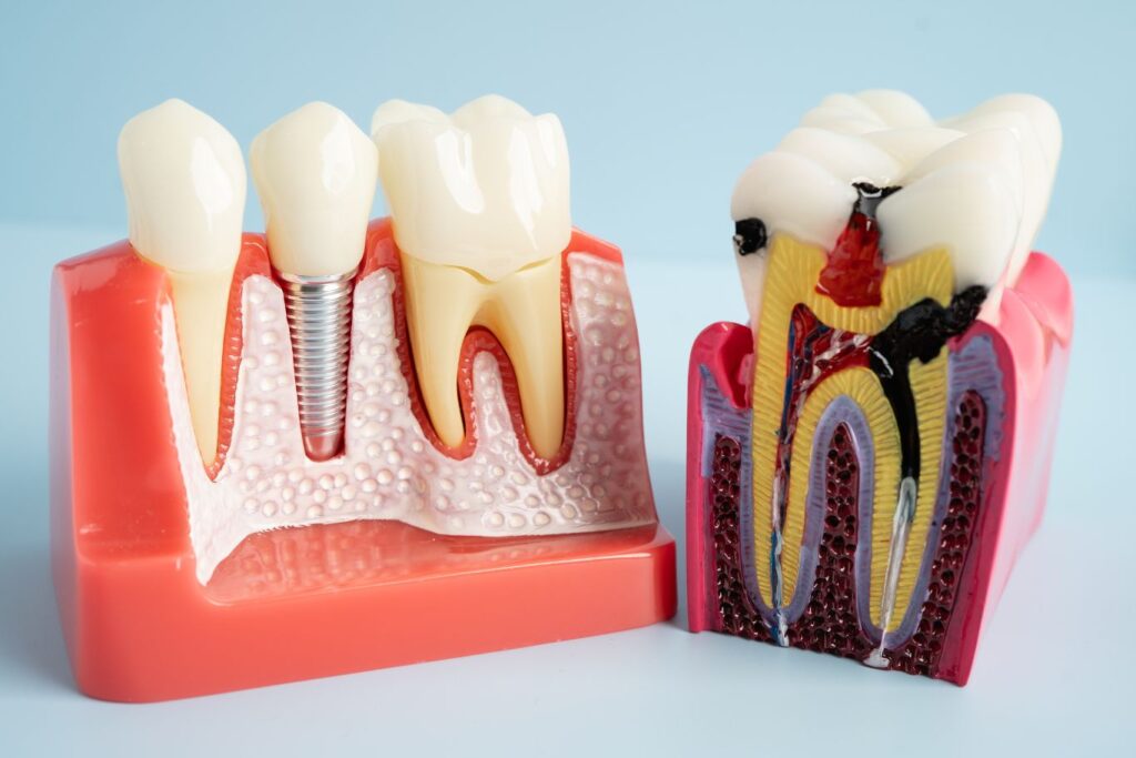 A root canal typodont and a dental implant typodont