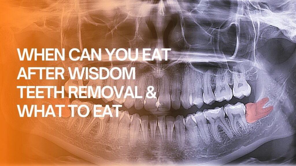 When can you eat after wisdom teeth removal?