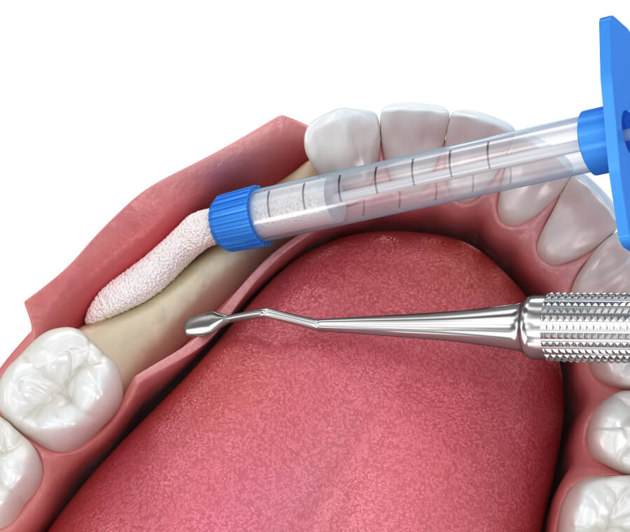 Are You a Candidate for Bone Grafting?