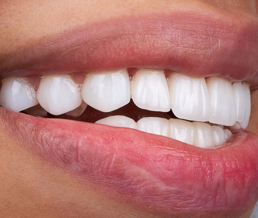 Perfect Your Smile with Dental Bonding