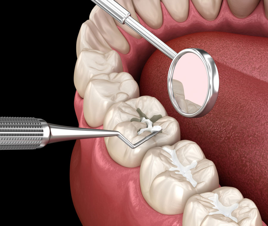Shield Your Smile with Dental Sealants