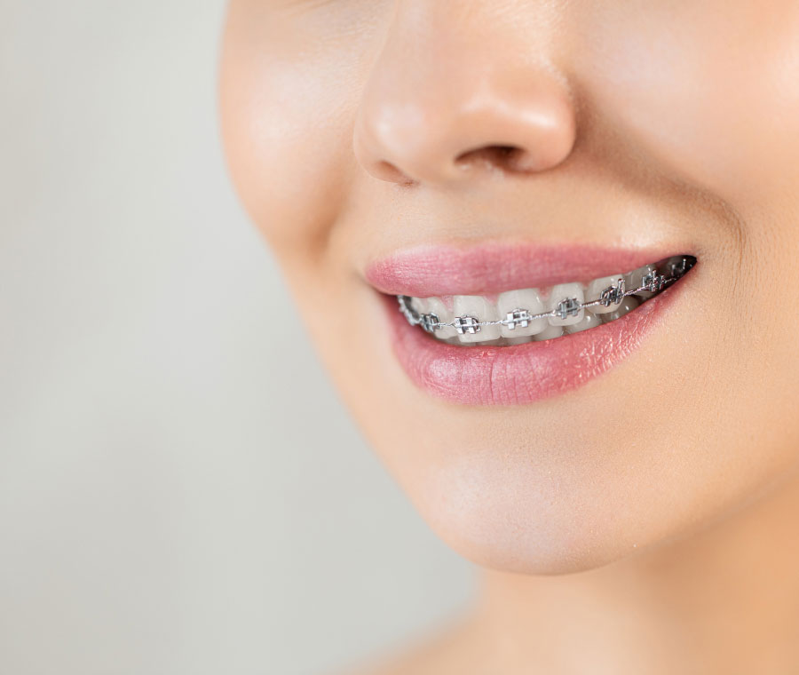 Benefits of Metal Braces