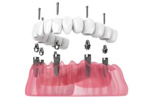 Lower arch, 3 on 6 dental implants