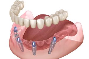Lower arch, all on 4 dental implants