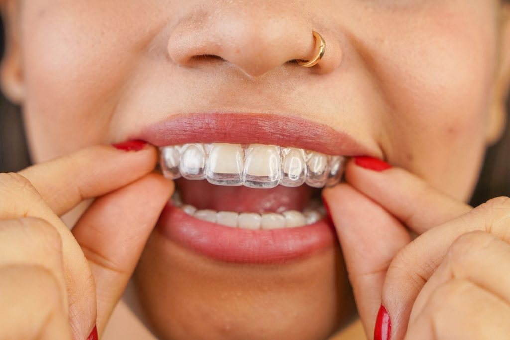 Close up of a mouth of a woman putting on her clear aligners