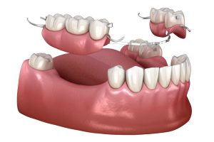 Lower Arch, fixed or removable implants