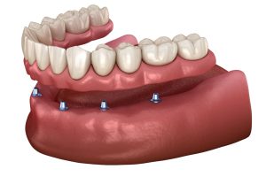 Lower dental arch, Implant - Supported dentures