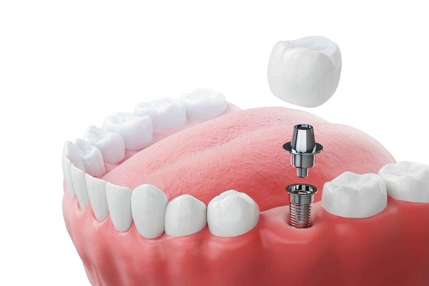 Lower arch, mini dental implant