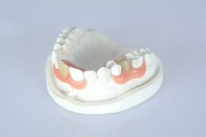 Teeth in a day prosthesis