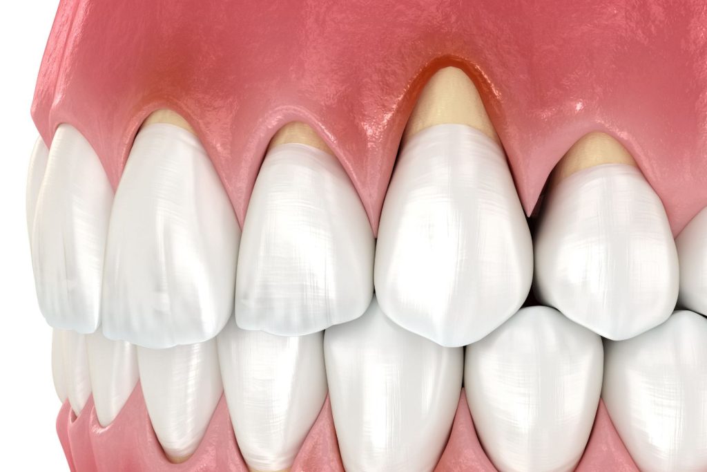 3D illustration of a mouth showing severe gum recession affecting several teeth in the upper jaw