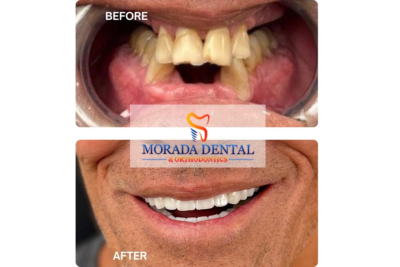 Before and After dental implant patient at Morada Dental & Orthodontics