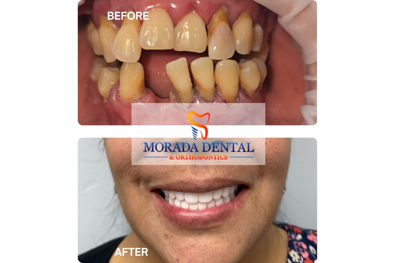 Before and After dental implant at Morada Dental & Orthodontics