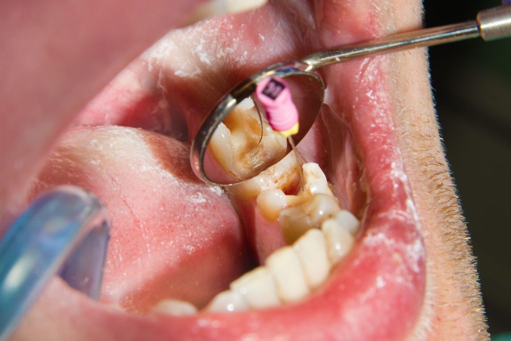 Close up of a mouth with a root canal treatment