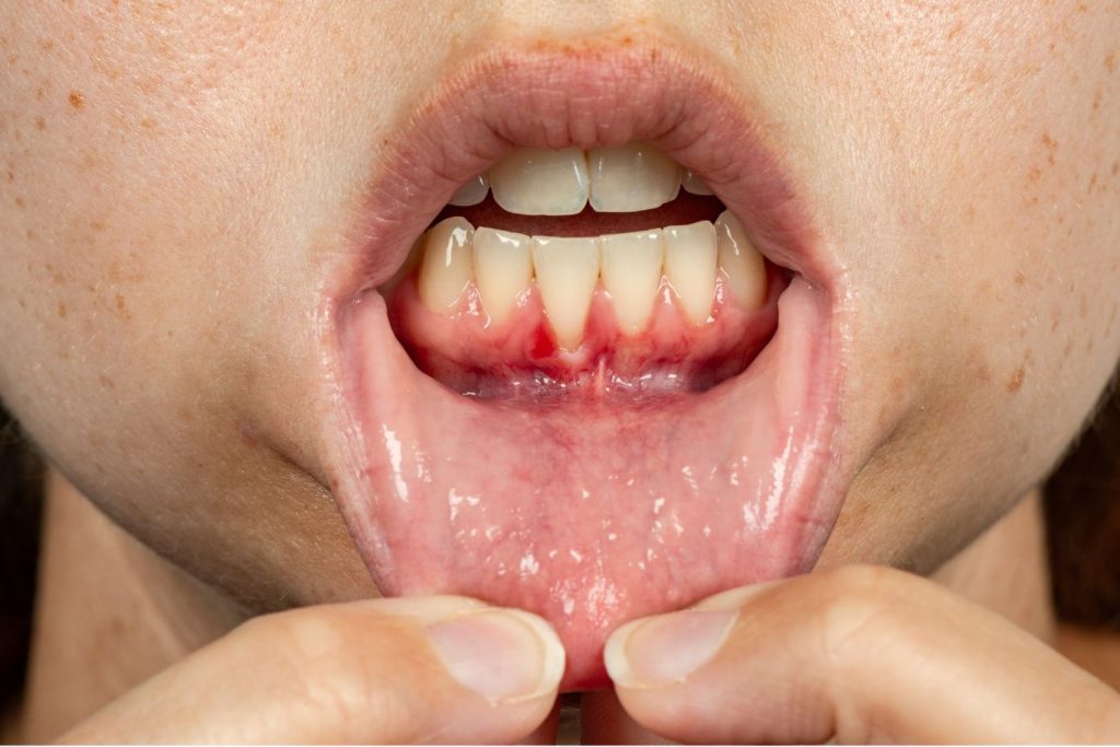 3D illustration of a mouth showing severe gum recession affecting several teeth in the upper jaw