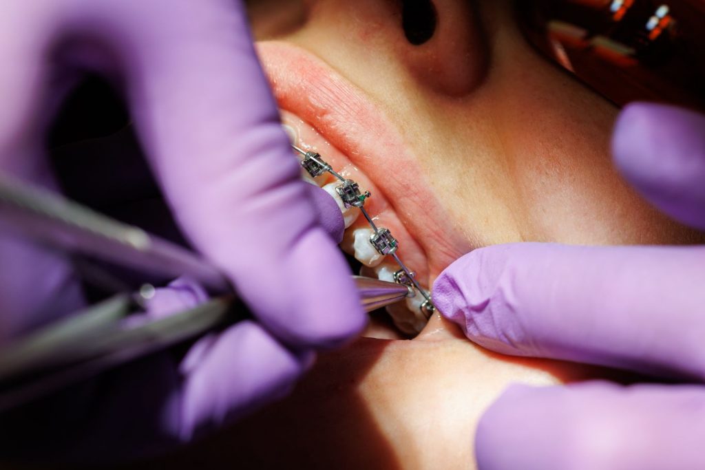 A close-up view of a dental professional wearing purple gloves adjusting metal braces on a patient’s teeth using orthodontic instruments